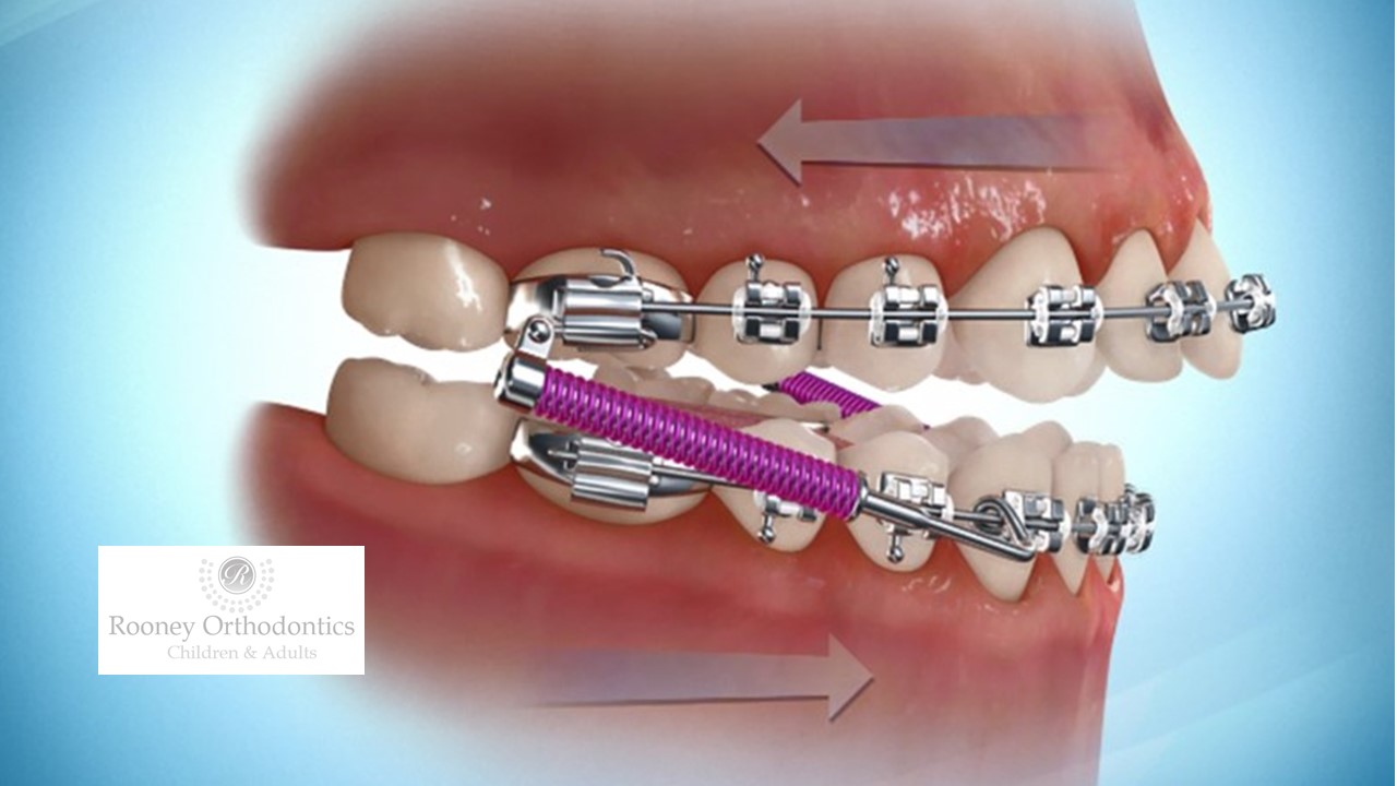 Forsus™ Dr. Sean M. Rooney Children & Adult Orthodontics Mahopac NY