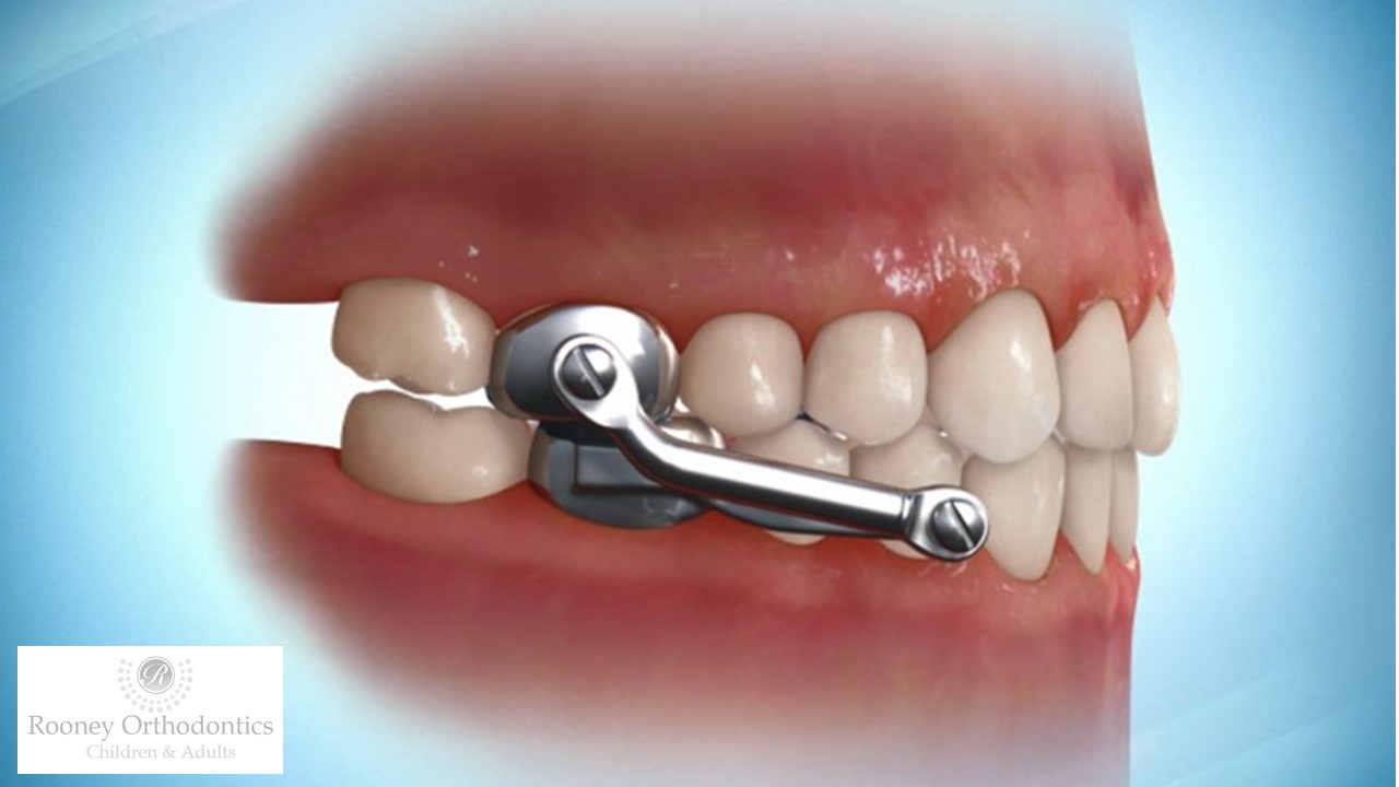 Types of Appliances Dr. Sean M. Rooney Children & Adult Orthodontics